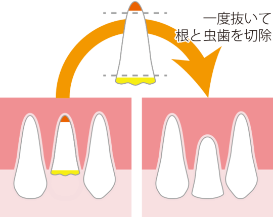 再植・移植について - 米山デンタルオフィス（三島市）